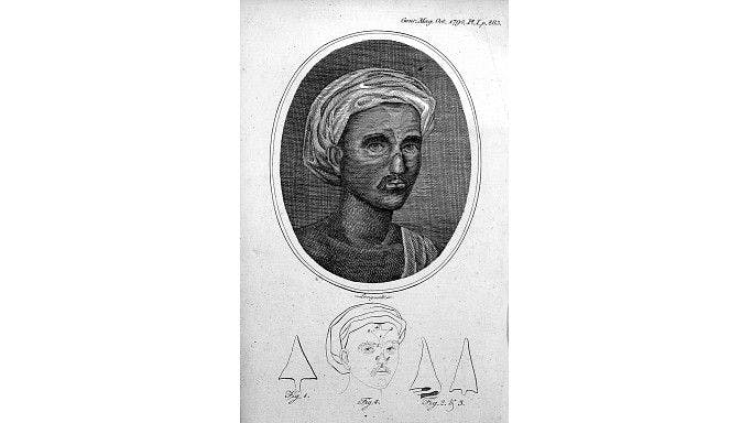 An illustration in the Gentleman’s magazine in 1874 titled Indian method of nose reconstruction based on Sushruta Samhita