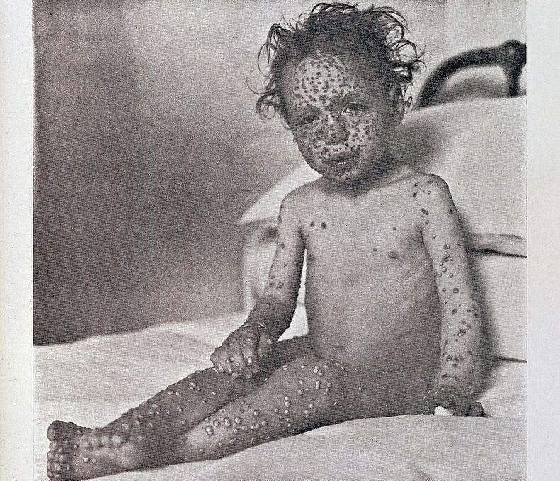 A child with smallpox